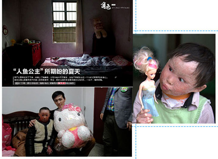 China's First Rare Ichthyosis Rescue Organization-Saving Ichthyosis Patients Operation