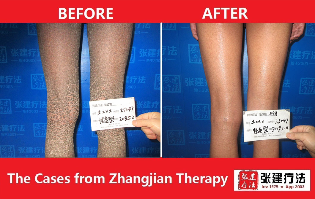Treatment Case Series--legs