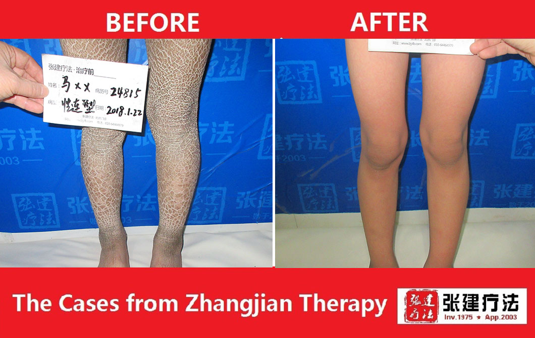 Treatment Case Series--legs
